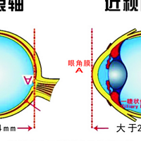 近视到底能不能逆转？哪些才是科学预防近视的方法？