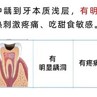 补牙人的小课堂，科普哪些情况需要补牙和预防龋齿的方法！