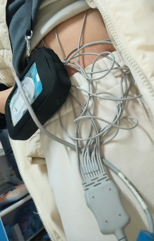 华为手环9提示早搏房颤—24h动态心电图检测