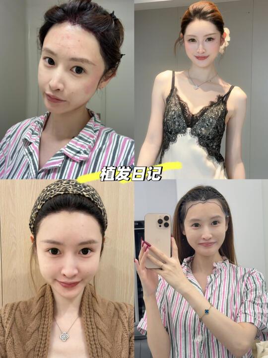 不剃发植发后，我也拥有头包脸啦！👩🏻