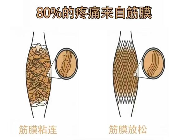筋膜枪真的有用吗?筋膜粘连降低脂肪代谢