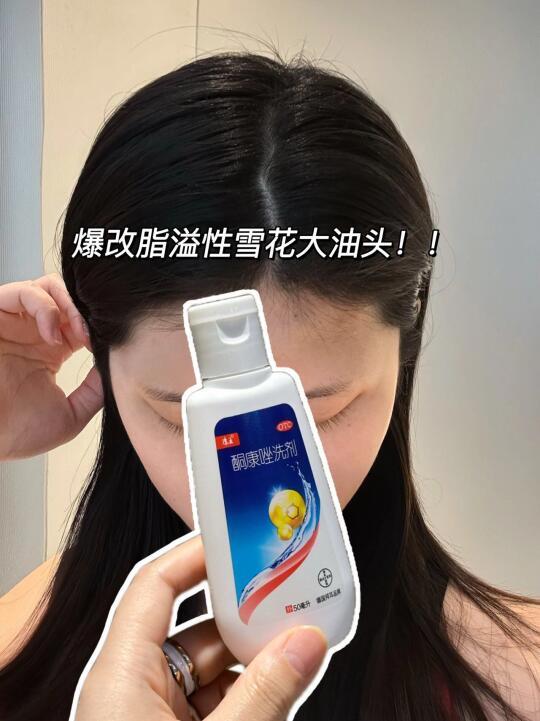 8年脂皮人血泪警告：头皮又痒又红又油快停手