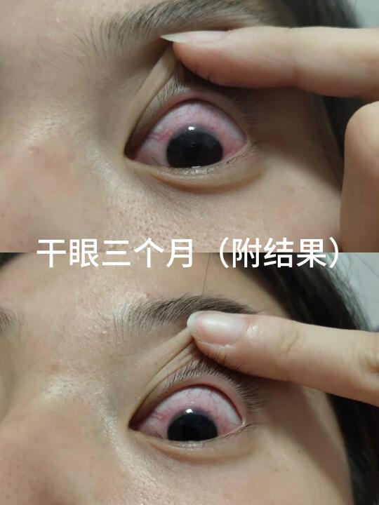 服用一年叶黄素的眼球变化（附结果）