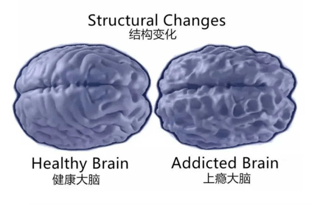 “脑腐”来袭,大脑如何被悄然侵蚀?