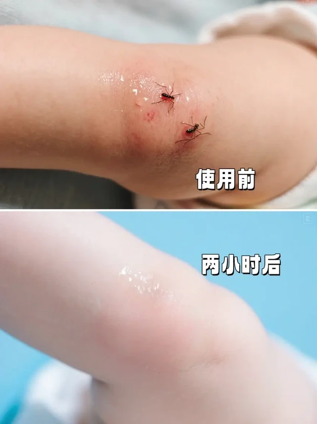 宝妈必看！夏日带娃不慌张这款神器守护全家。夏天蚊虫肆虐，宝宝肌肤娇嫩易敏感，当妈的心都揪起来了！BOIRON宝弘金盏花修护膏来救场啦～ 🌼 天然植物萃取，温和到不行，给宝宝涂一抹，轻盈乳霜质地秒吸收，