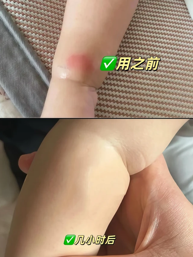 夏日必备指南，轻松应对夏日困扰，守护全家随着气温升高，各类昆虫活动频繁，皮肤敏感人群尤其需要贴心呵护。BOIRON宝弘金盏花修护膏采用天然植物萃取技术，为日常防护提供新思路:

轻盈触感:乳霜质地轻盈