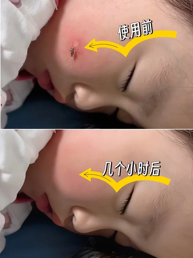 夏日敏感肌救星！宝弘金盏花修护膏闭眼入。宝子们，夏天到了，蚊虫撒欢儿，皮肤敏感的家人简直苦不堪言😭 还好我发现了 BOIRON 宝弘金盏花修护膏，夏日全家防护就靠它啦！

🌿质地超绝：乳霜质地轻盈得不