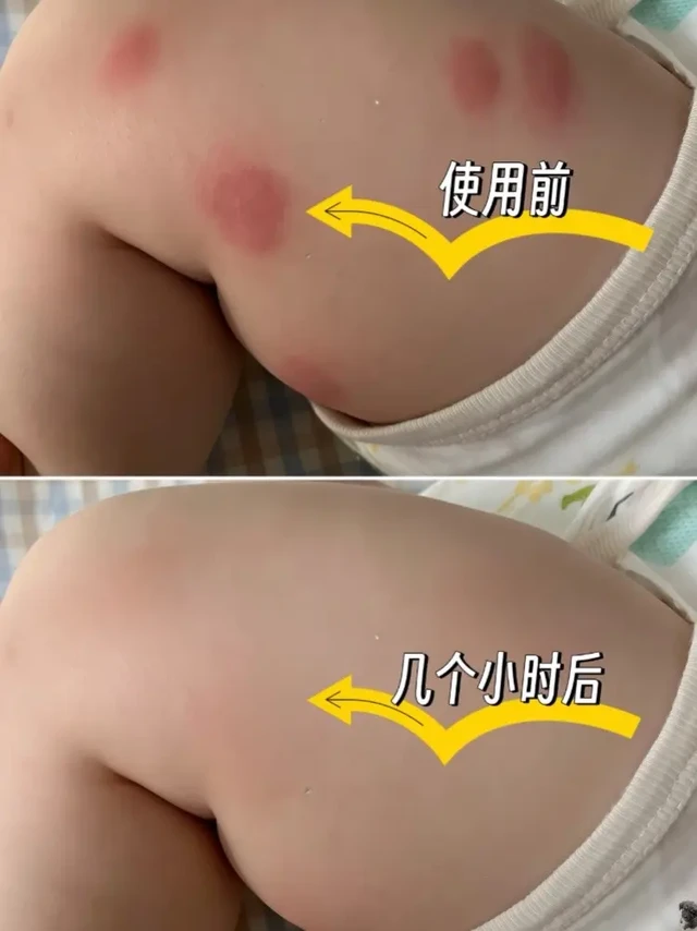 被问N次的夏日肌肤救星！宝弘金盏花修护膏。家人们，夏天一到，蚊虫肆虐，敏感肌真的要哭晕😭 不过别怕，我挖到宝了！BOIRON 宝弘金盏花修护膏，简直是夏日全家肌肤的守护神！

🌿质地：轻盈乳霜质地，像