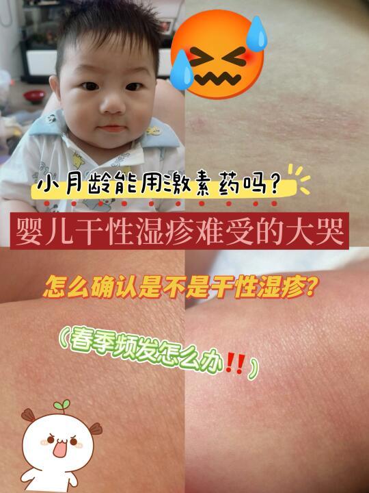 婴儿干性湿疹怎么办？‼️什么是干性湿疹？