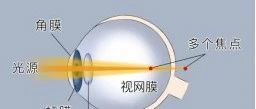 戴功能眼镜会让散光增加吗？