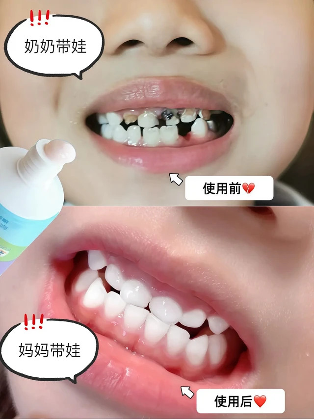 郭晶晶代言的儿童牙膏，闭眼入！

被我挖到一款跳水冠军郭晶晶代言的儿童牙膏——舒客宝贝抗糖防蛀牙膏，有娃家庭必看！

我家娃平时超爱吃甜食，可把我愁坏了，生怕他长蛀牙。做了好多功课，终于找到这款宝藏牙