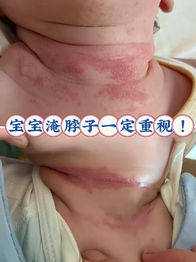 🌈夏日救星!宝宝的肌肤小卫士
宝妈们,一到夏天,是不是总担心宝宝娇嫩的肌肤被汗水和热气欺负?别愁啦,我给大家挖到宝了——十月结晶金盏花婴儿爽身粉,用过就离不开!
🌼金盏花植萃,舒缓小能手
这款爽身