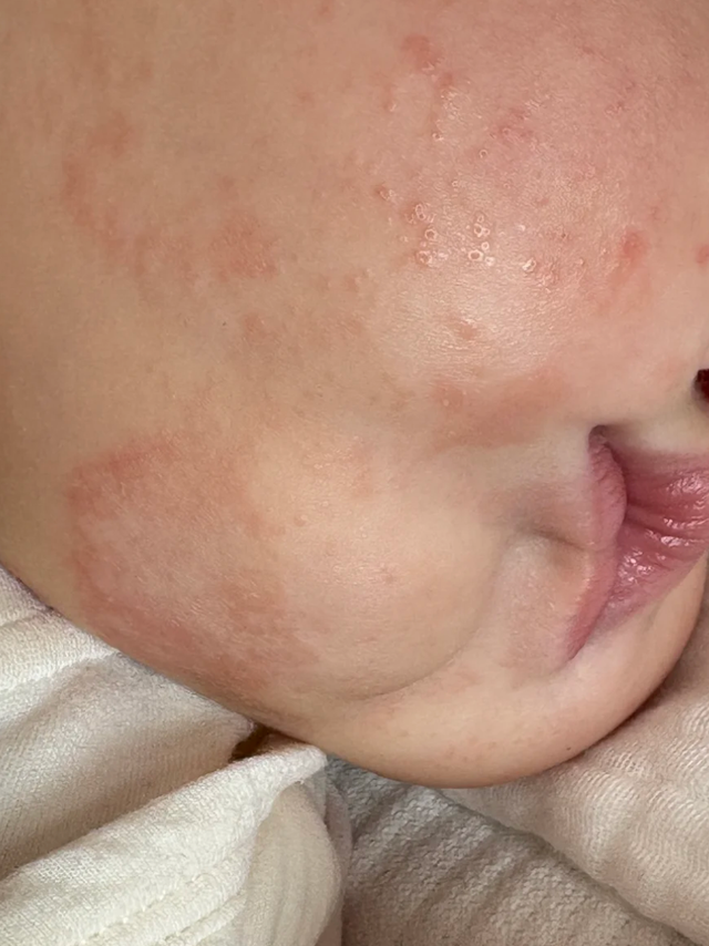 婴儿湿疹是什么原因？湿疹宝宝如何护理｜避开3大误区+5步急救法