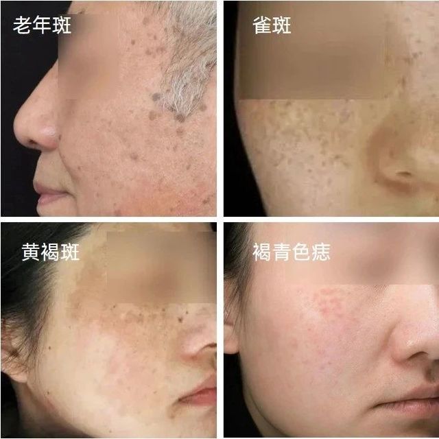 激光是祛斑的「最优解」吗？ 一文扫盲