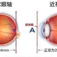 眼轴检查：近视防控的“隐形指标”，三个方法教你保护视力