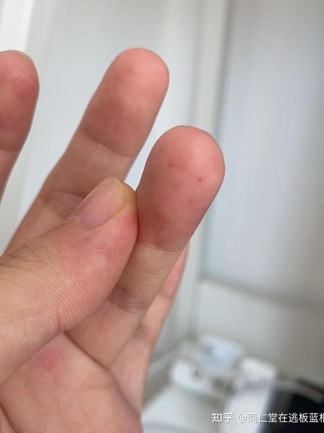 查出来血糖高，建议买个家用血糖仪吗？动态血糖仪真的好用吗？内附自用分享！