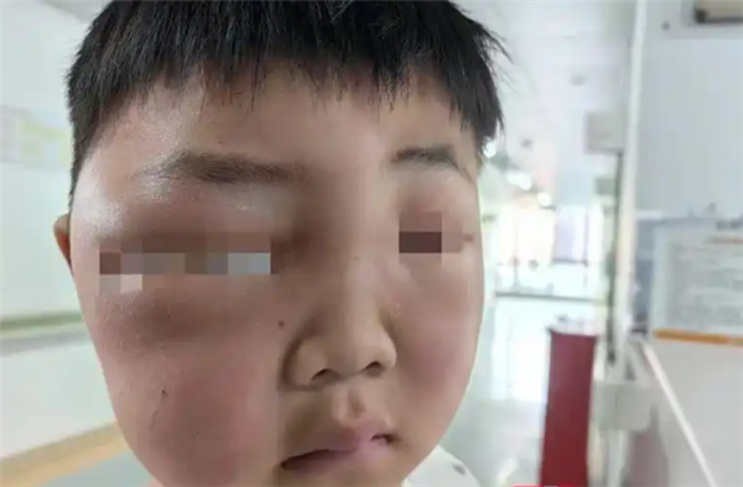 男孩一觉醒来脸肿成“发面馒头”:被蚊虫叮的面目全非