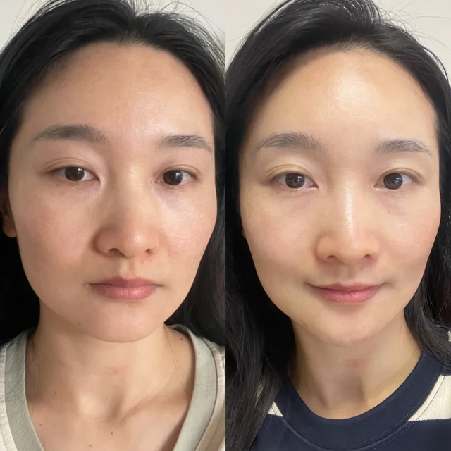 30+宝妈垮脸自救，美容仪真不是智商税☑