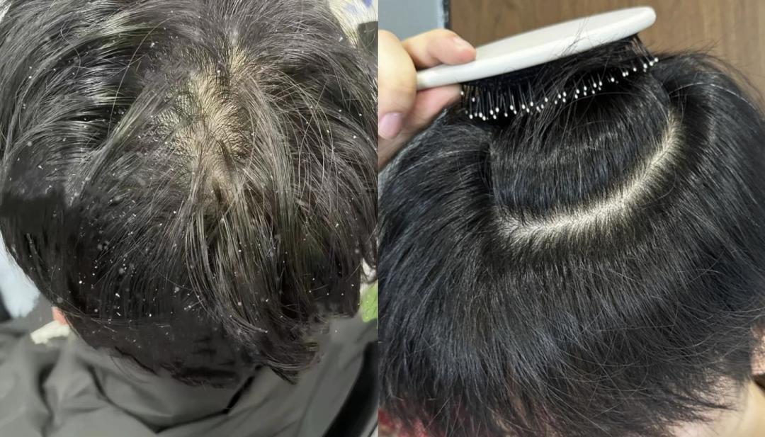 头皮屑全攻略：4大诱因解析与分型护理科学指南