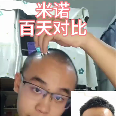 米诺地尔真的有效吗？这个价格贵么？