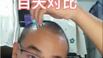 米诺地尔真的有效吗？这个价格贵么？ 