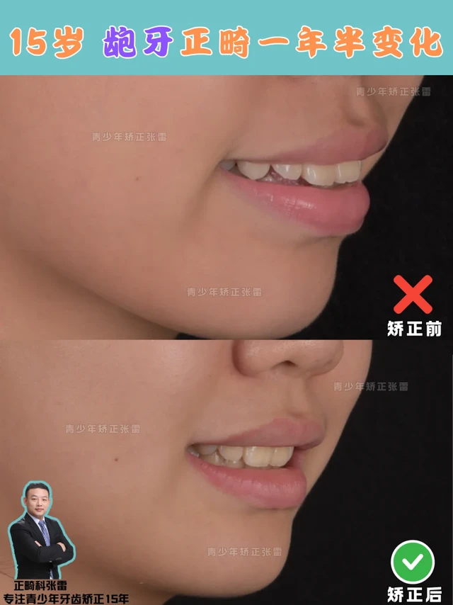 青少年矫正| 正畸一年半，龅牙终于变齐了