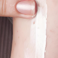 我国原研银屑病外用新药本维莫德乳膏，适用哪些炎症性皮肤病？