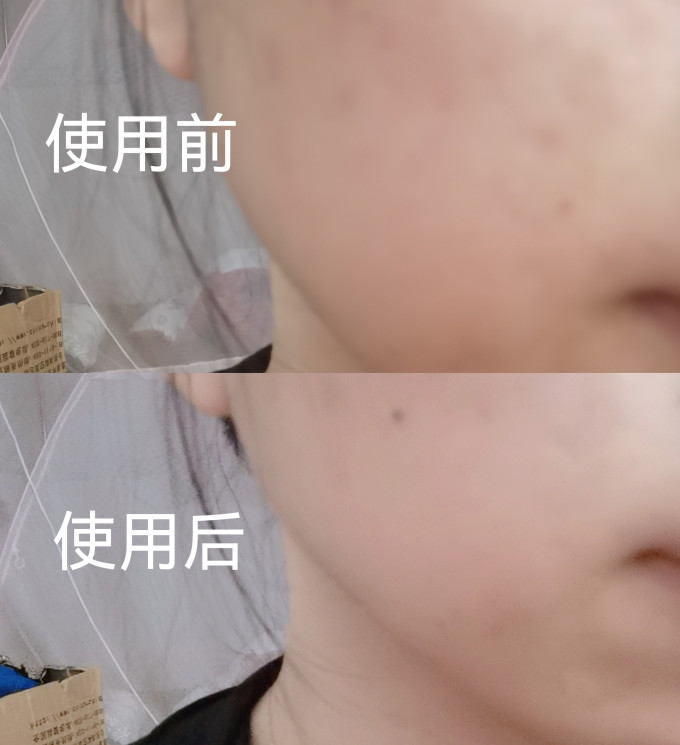 敷尔佳面部皮肤管理