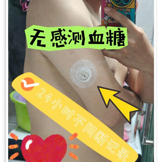 无痛无感24小时监测血糖，欧态血糖仪太好用了！