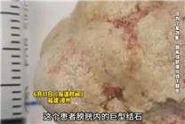 男子爱吃烧烤海鲜长出巨型结石 医生：建议每天喝3升水