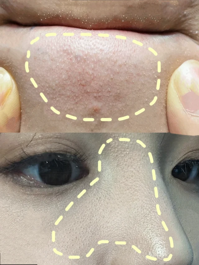 鼻子两侧和下巴总有白色分泌物的姐妹🙋有共鸣吗？
不化妆还好，一上底妆就积线、起皮、显得特别不干净🥲
👇这些其实可能是白头闭口，也可能是油脂粒，常见诱因包括：
✅作息不规律、皮肤清洁不到位
✅偏爱凉食，