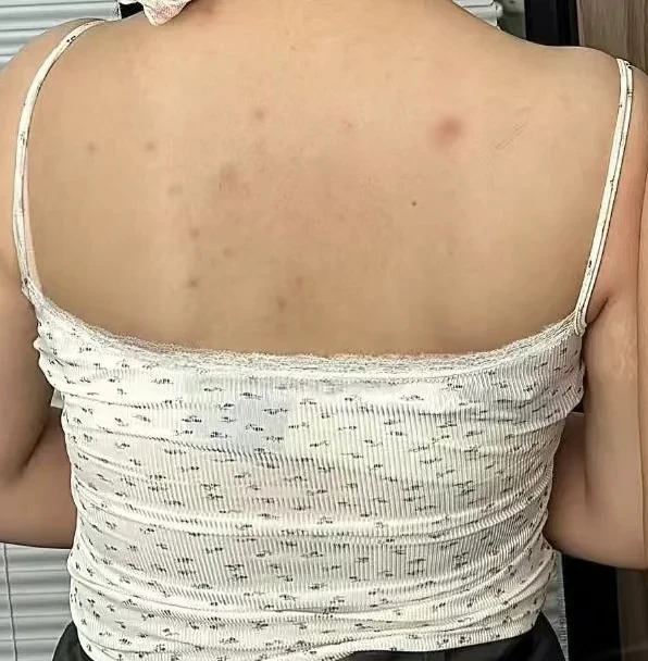 后背痘痘，已经坚持用药两周啦