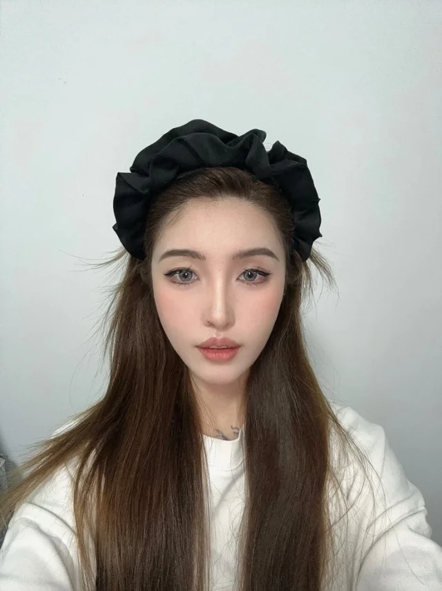 雍禾植发|广州女生发际线种植1年效果公开！