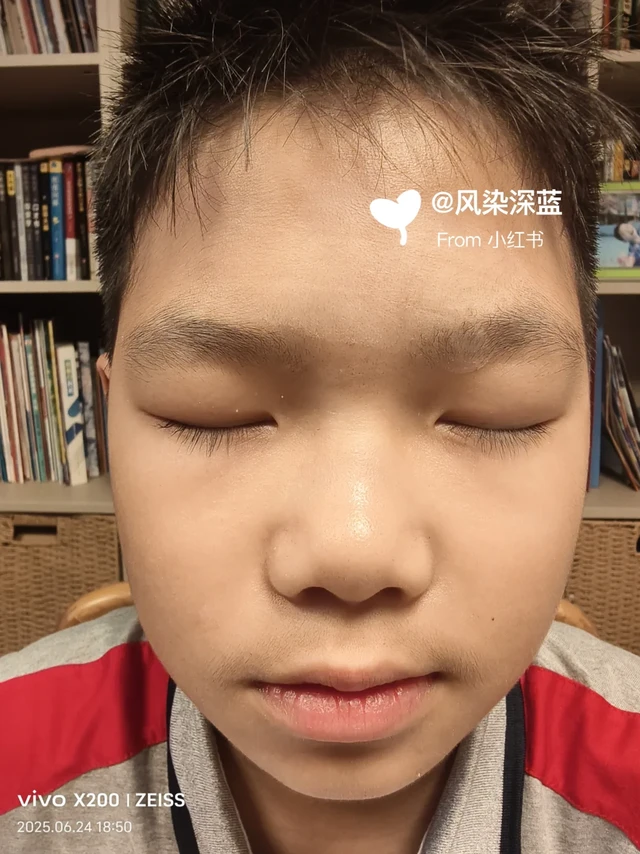 受伤6个月零14天,疤痕实拍