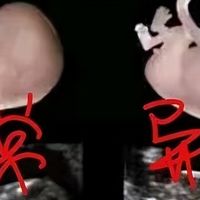 胎儿无左手是否该留下来？