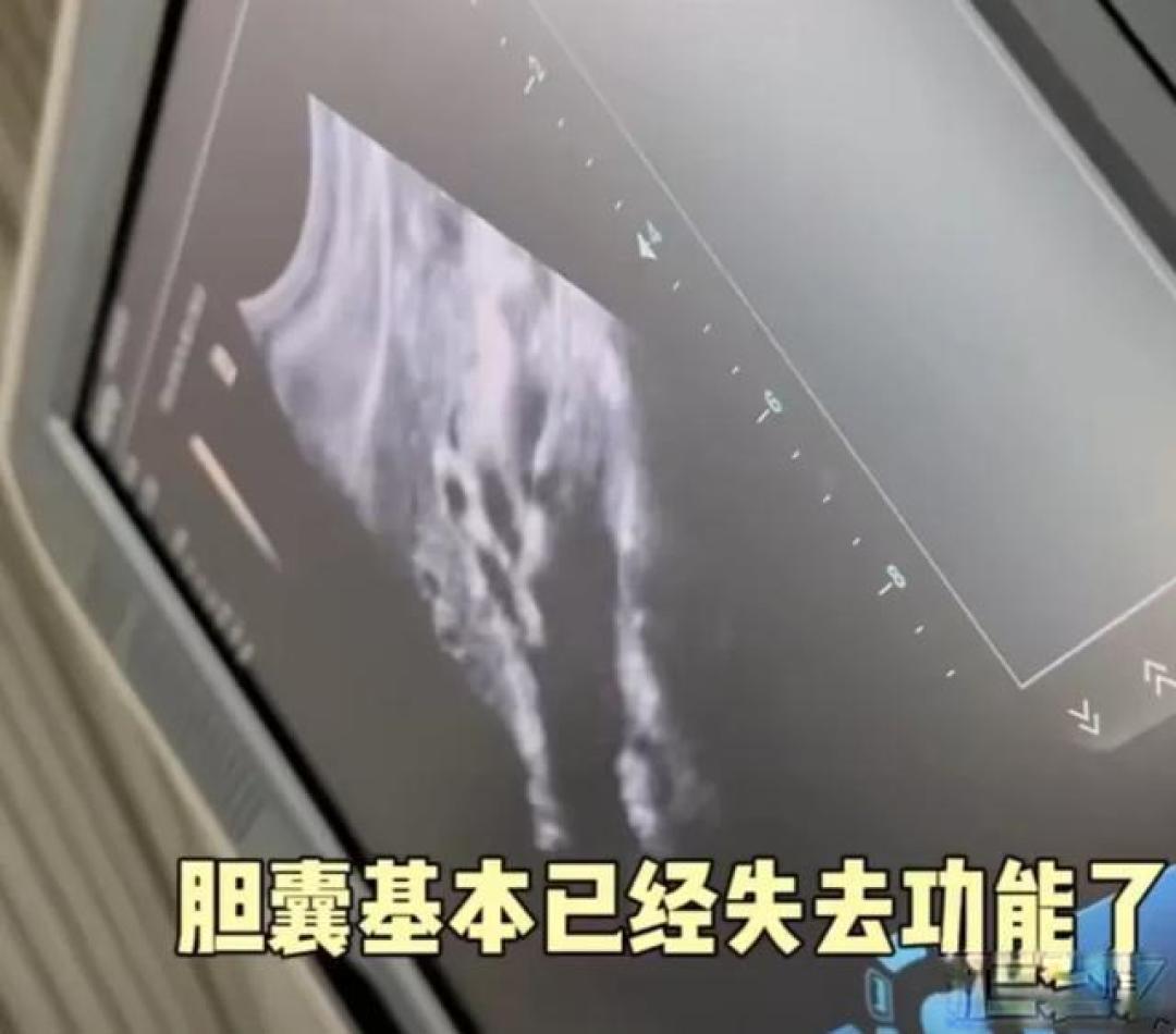36岁颖儿切胆自述:每10人就有1中招的胆结石有多痛?