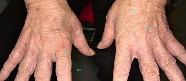 你也痒，我也痒，可能得了疥疮喔！