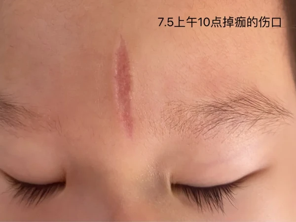 掉痂后伤口很宽凹陷了