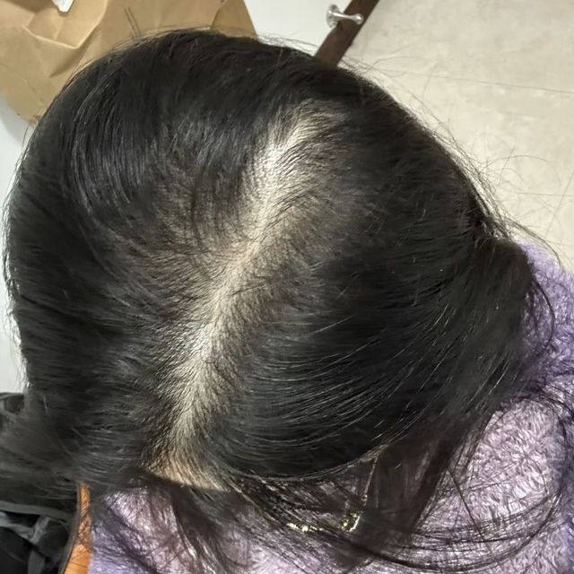 我的脱发每日坚持记录