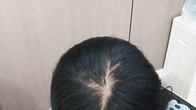  感谢自己的坚持，脱发好了很多