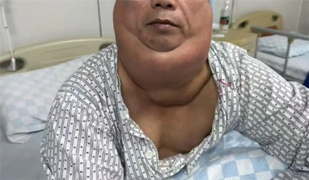 男子每天1斤酒喝出“河马颈” 医生:长期饮酒警惕脂肪异常堆积