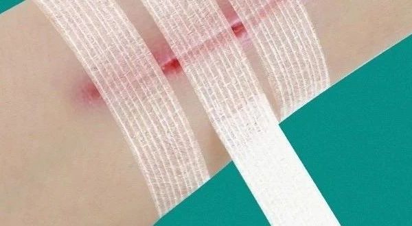 疤痕减张贴的科学使用——患者实用指南