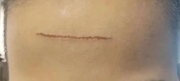 轻松淡化疤痕的妙招！全家都适用！