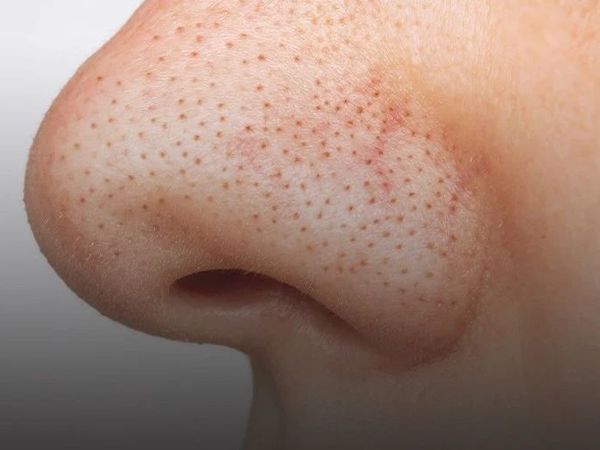 黑头反反复复去不掉？可能它本来就不是黑头！