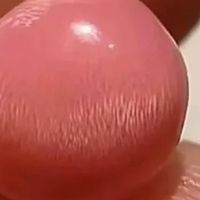 巨有用的痔疮肉球消除方法！混合痔、痔疮肉球疼痛照着做！