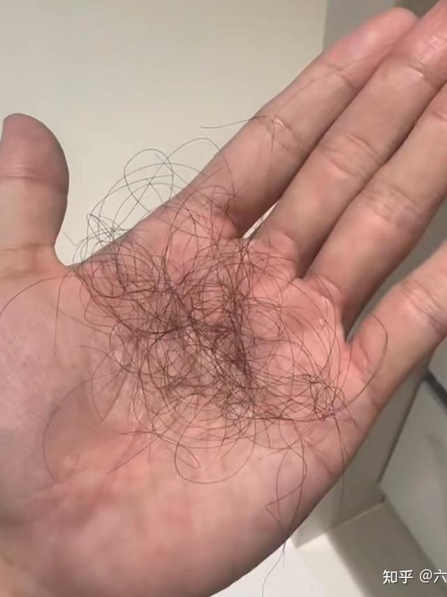 油头自救实录，医生教我的控油救命法，拯救秃顶危机