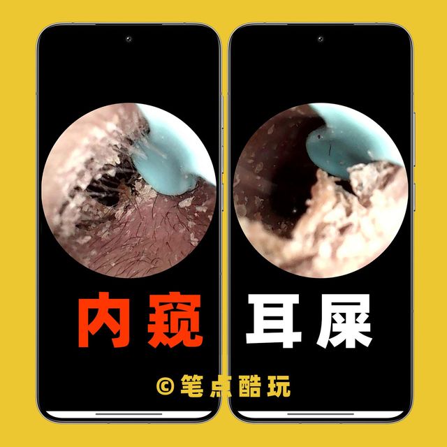 内窥耳屎！要不是亲眼所见，我还以为我耳朵有多干净！