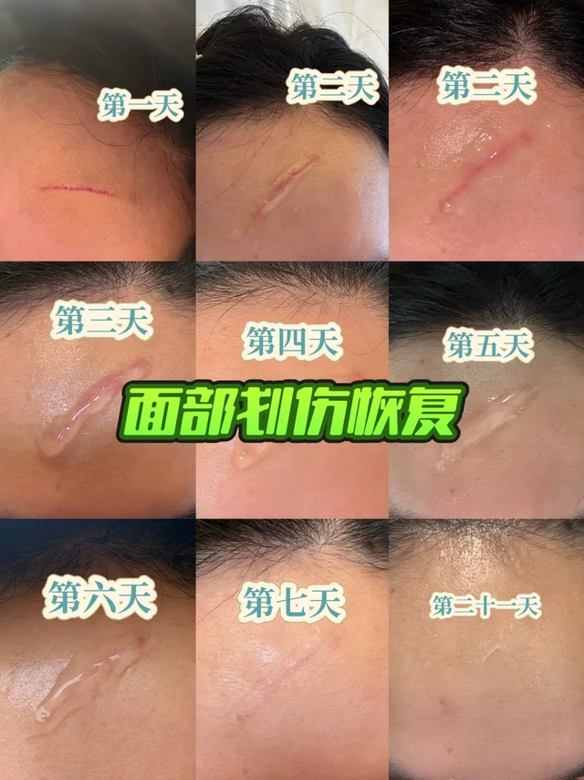 4月初脸部剐蹭到尖锐物品，直接掉了一层皮，作为60天结婚倒计时的新娘子，直接崩溃，马不停蹄奔去医院，中午时段只能挂急诊，急诊医生一看就说会留疤，五雷轰顶，简单处理后，医生建议去挂医疗美容科，开了生长因