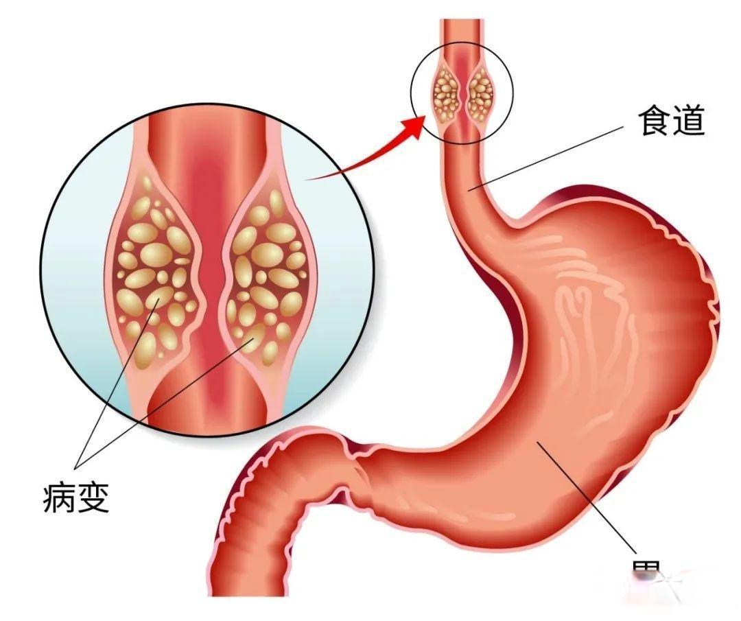 烫食与腌菜:中国食管癌为何占据全球半壁江山?