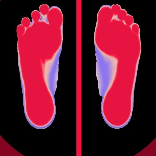 足底筋膜炎:一个月从疼痛难忍到逐步缓解,我做了这些